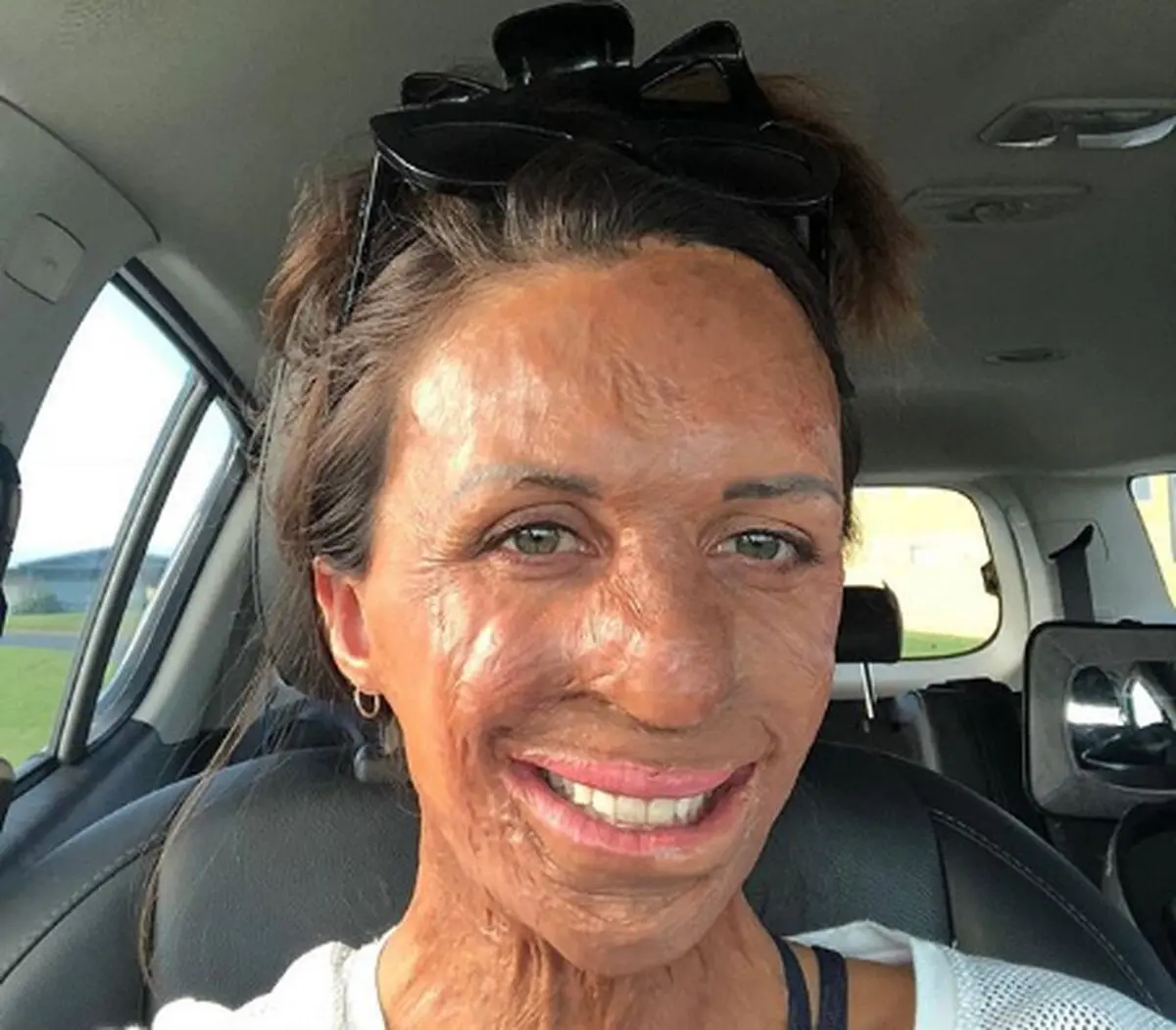 زندگی با زن ورزشکار و مدل پس از سوختگی صورت و بدن +عکس