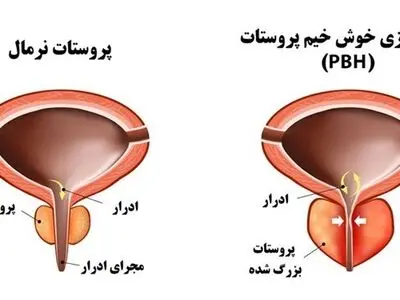 بهترین روش جراحی و درمان پروستات با بخار آب به کمک دستگاه رزوم