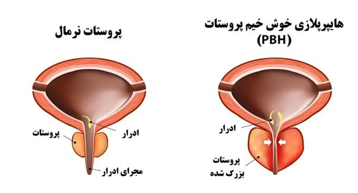 بهترین روش جراحی و درمان پروستات با بخار آب به کمک دستگاه رزوم