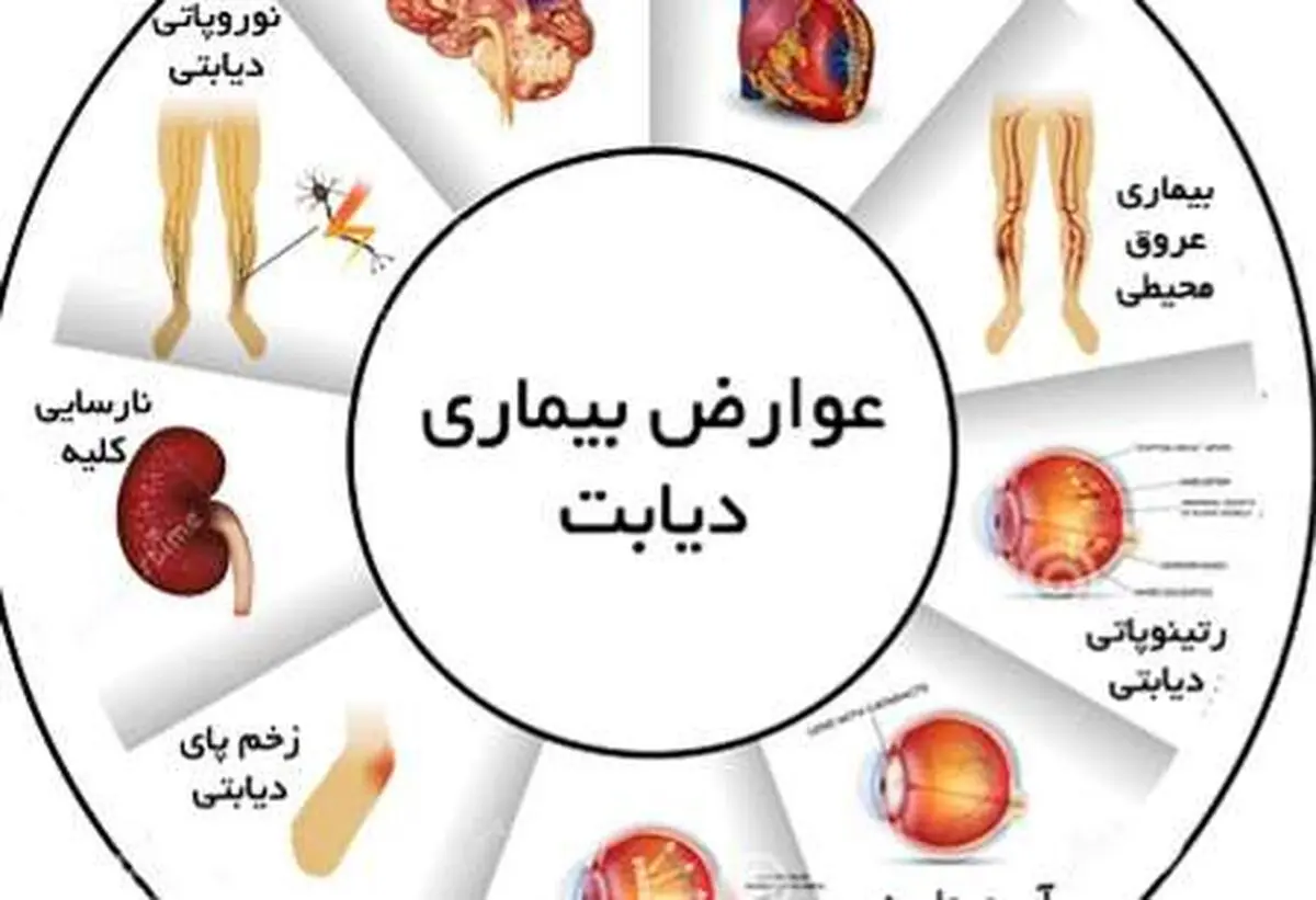 ۱۱.۵ تا ۱۳ درصد از جامعه ایرانی مبتلا به دیابت هستند/ پیشگیری از دیابت با گسترش آموزش به مردم