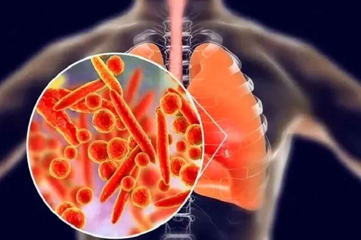 بیماری انسدادی مزمن ریه چهارمین علت مرگ‌ و میر جهان است 