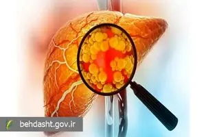 هشدار دفتر بهبود تغذیه جامعه وزارت بهداشت به درمان نادرست کبد چرب

