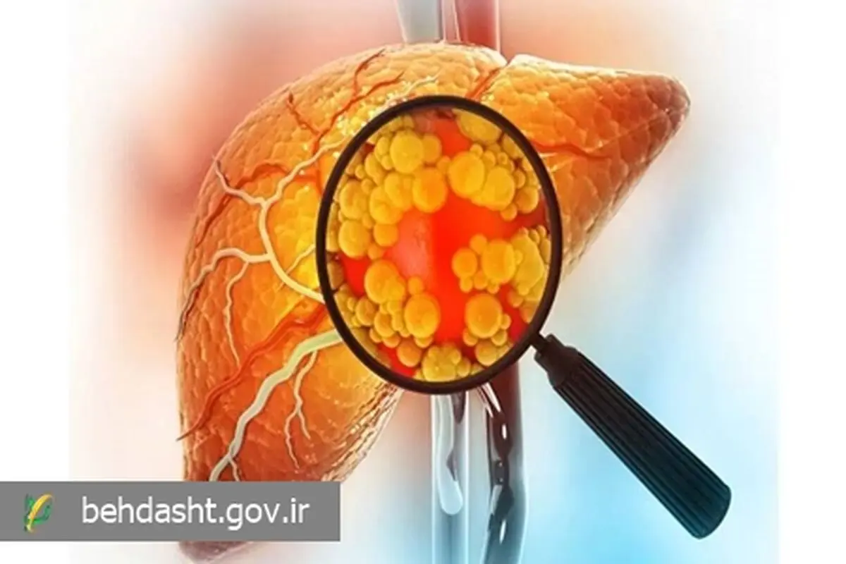 هشدار دفتر بهبود تغذیه جامعه وزارت بهداشت به درمان نادرست کبد چرب

