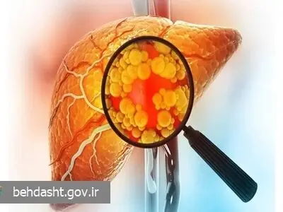 هشدار دفتر بهبود تغذیه جامعه وزارت بهداشت به درمان نادرست کبد چرب

