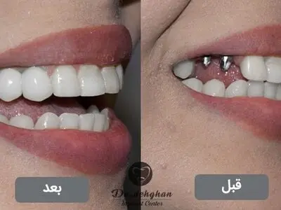 ایمپلنت فوری جایگزین همیشگی دندان از دست رفته