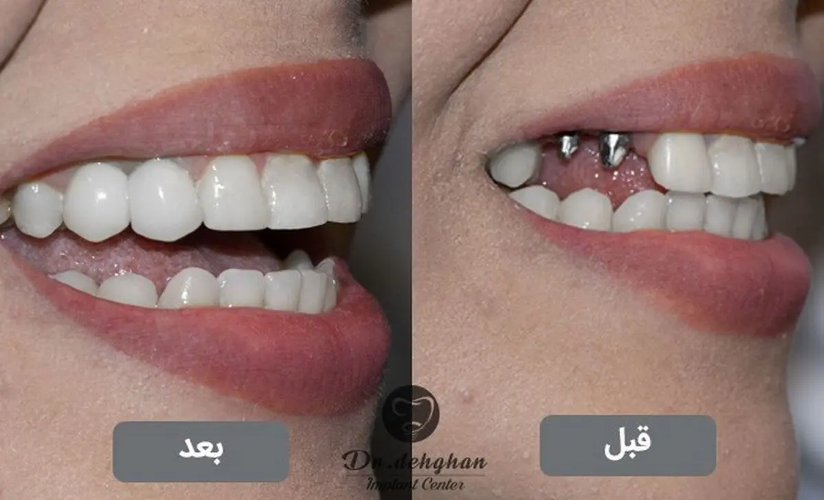 ایمپلنت فوری جایگزین همیشگی دندان از دست رفته