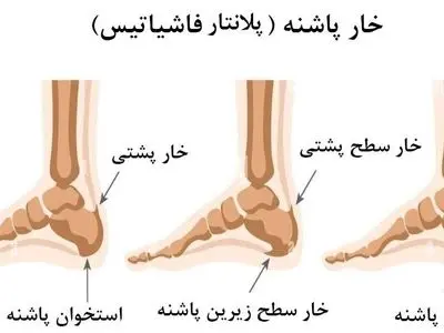اگر خار پاشنه دارید و از درد آن عاجز شده‌اید، بخوانید