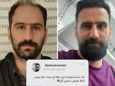 بهترین مرکز کاشت مو در تهران با ضمانت