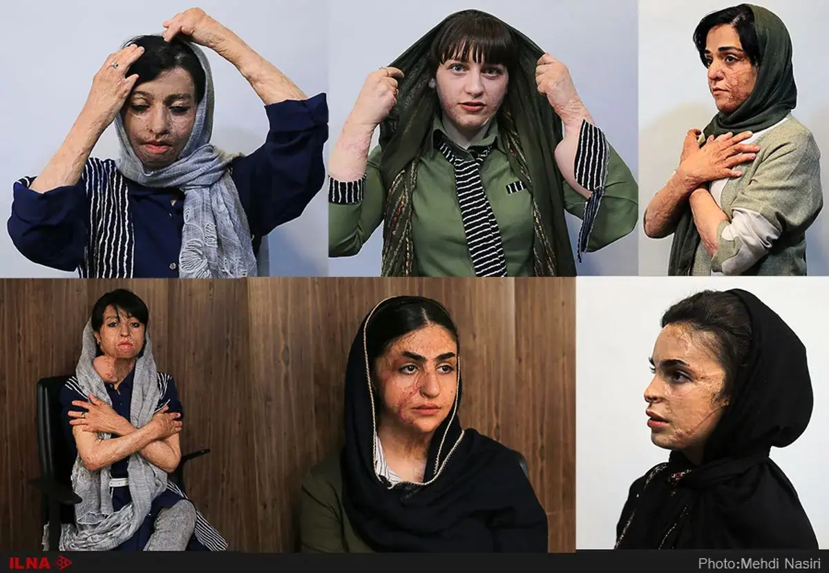 بوی تلخ مهر برای دختران سوخته شین‌آباد؛ ۵ دولت از پس درمان ۱۰ دختر برنیامدند