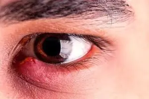 اشتباه ساده‌ای که برای چشم گران تمام می شود