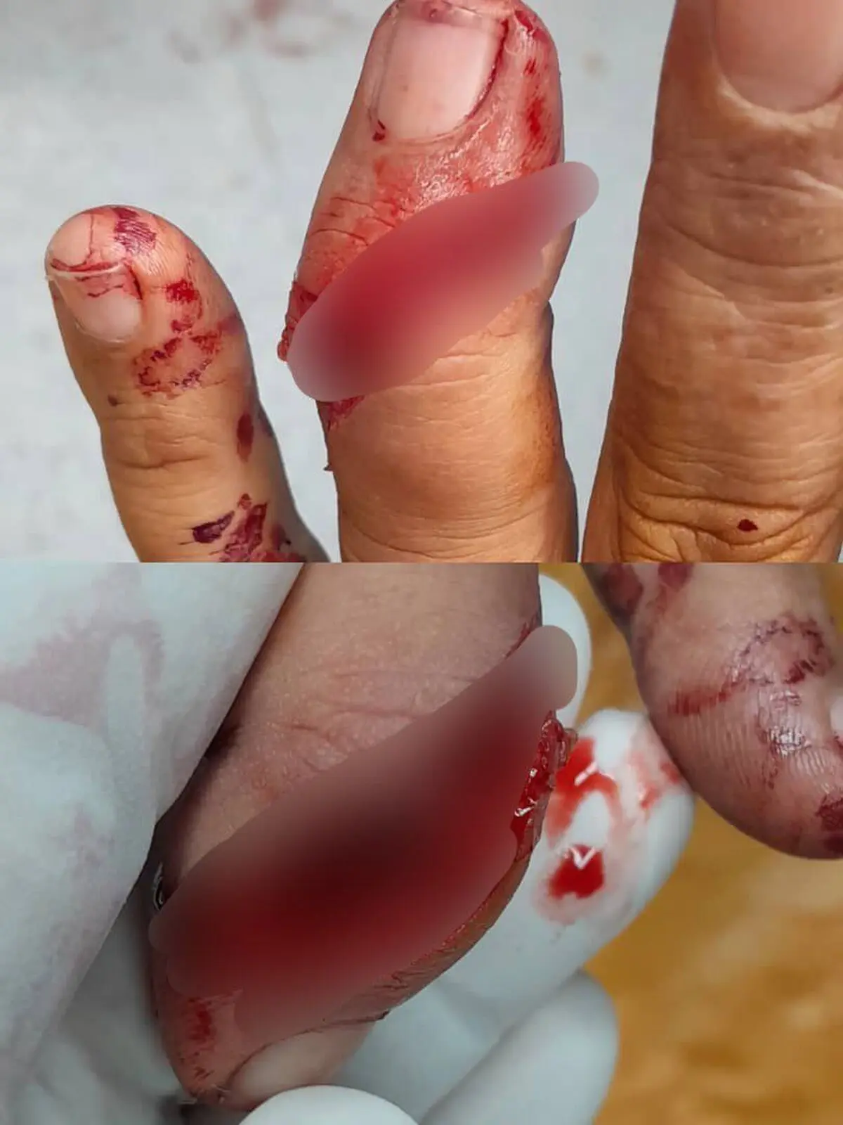 درگیری کارگران نگهبان هفت تپه با سارقان/ قطع دو انگشت یک کارگر 