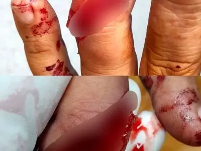 درگیری کارگران نگهبان هفت تپه با سارقان/ قطع دو انگشت یک کارگر 