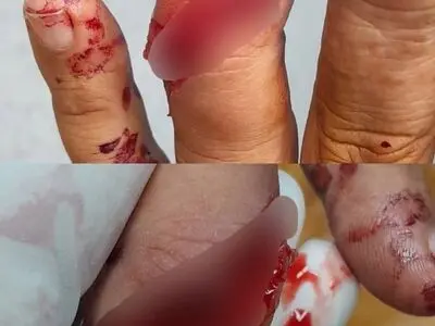 درگیری کارگران نگهبان هفت تپه با سارقان/ قطع دو انگشت یک کارگر 
