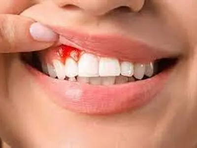 رایج‌ترین علت خونریزی لثه هنگام مسواک زدن