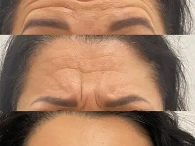 عوارض تزریق ژل بوتاکس و لیزر موهای زائد - مولفه های یک کلینیک زیبایی معتبر چیست ؟ 