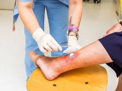 جدیدترین انواع پانسمان زخم و درمان زخم به روش نوین