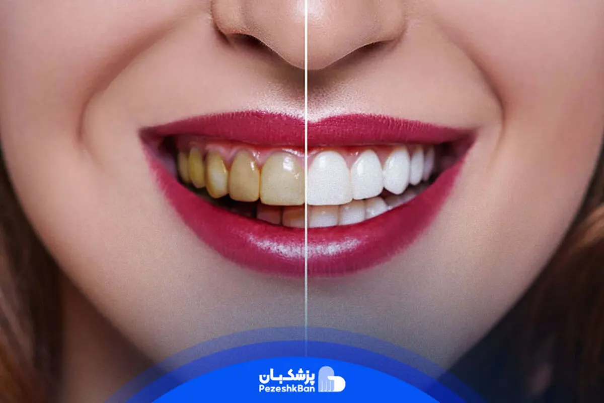 بلیچینگ دندان چیست؟ تخصصی ترین روش سفید کردن دندان