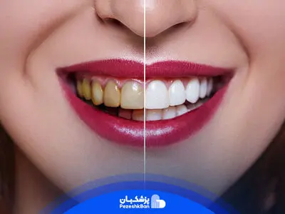 بلیچینگ دندان چیست؟ تخصصی ترین روش سفید کردن دندان