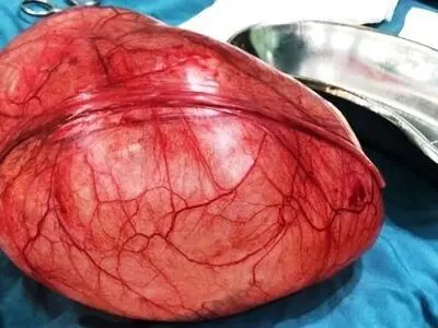 خارج کردن توده عجیب از شکم بیمار دهدشتی