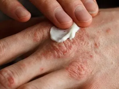 تغییر فصل، محرک اگزما نه عامل ایجاد آن