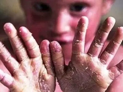 ۸۰ درصد بیماری‌های نادر ژنتیکی هستند