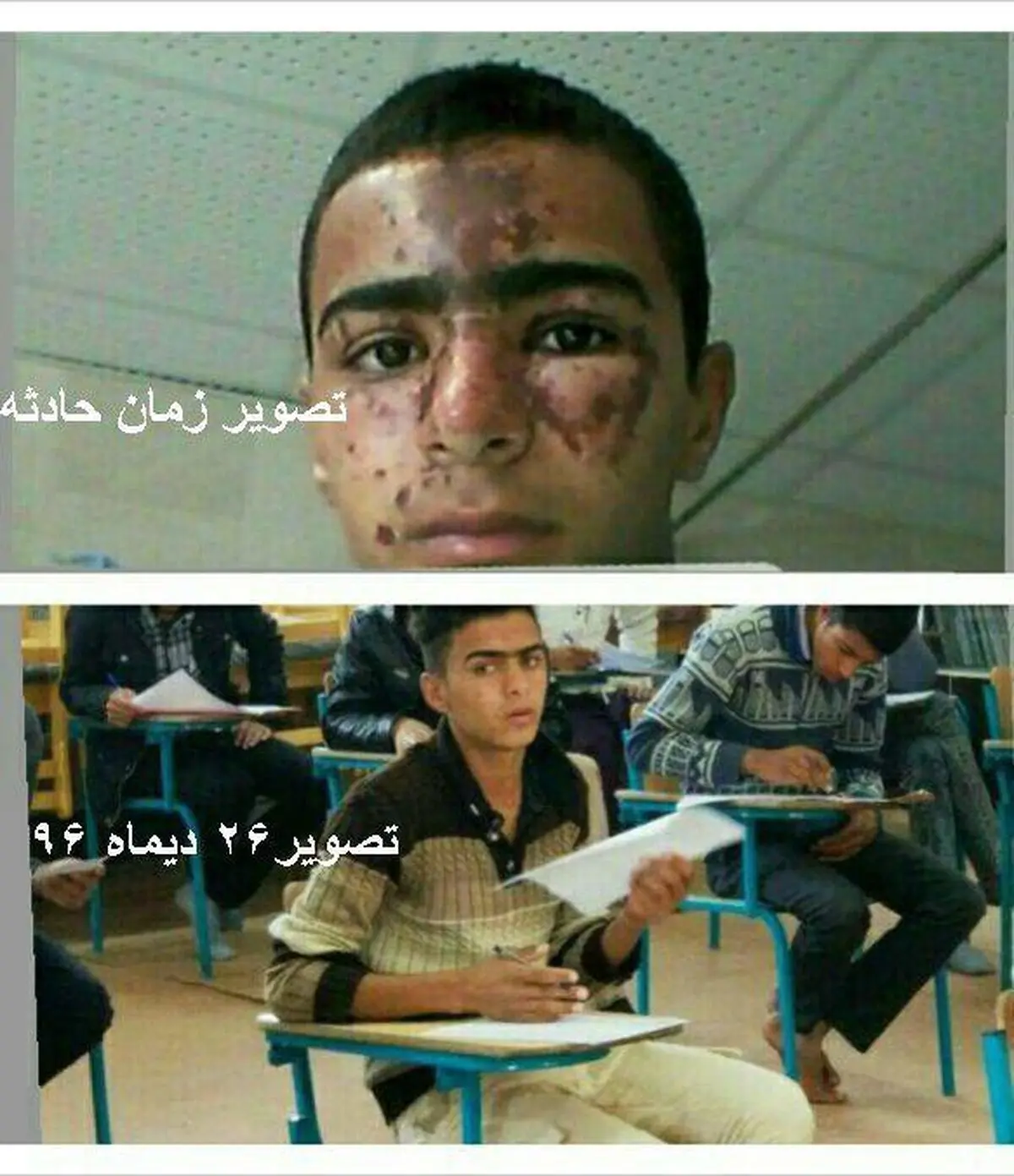 جزئیات حادثه سوختگی صورت دانش‌آموز زهکی در مدرسه/ نقص عضوی رخ نداده است