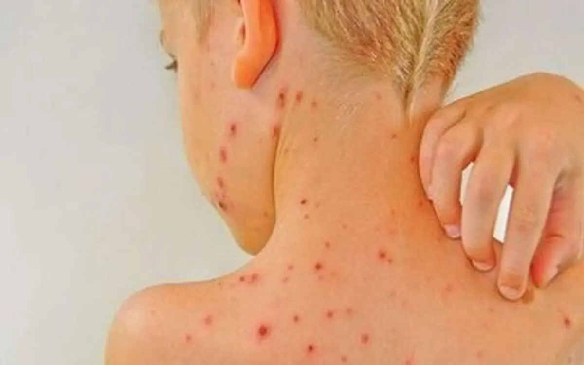 آبله مرغان برای چه افرادی خطرناک است؟/ عوارض احتمالی آبله مرغان