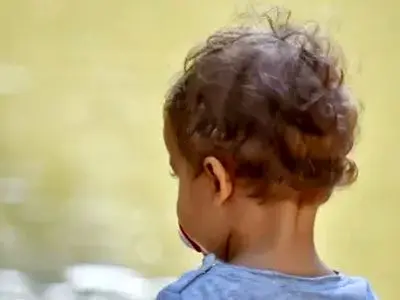 علت سفید شدن موی کودک