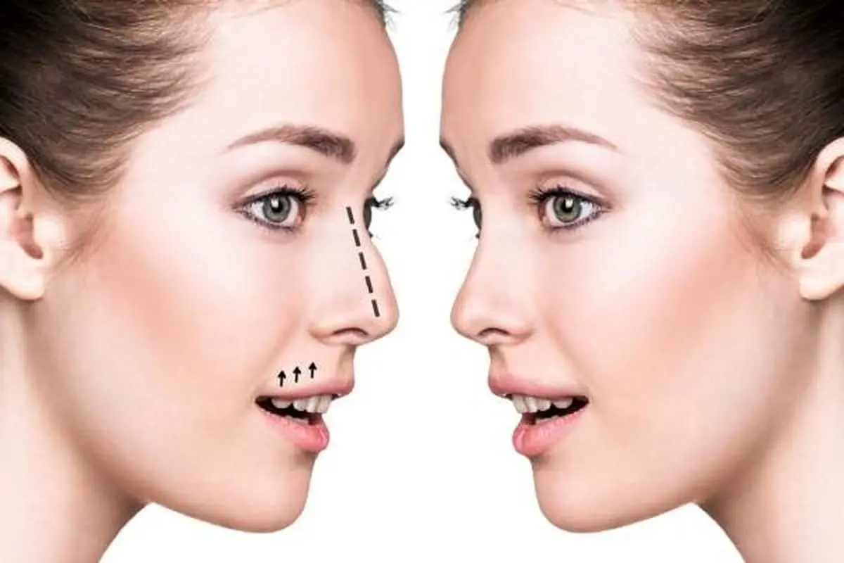 بهترین دکتر جراح بینی در کرج