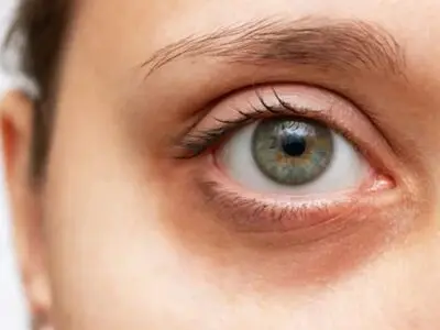 ۸ خوراکی برای بهبود سیاهی زیر چشم