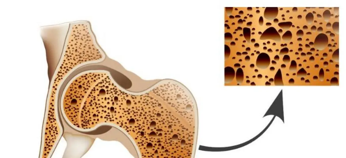 ۷ حقیقت شگفت‌انگیز درباره پوکی‌استخوان