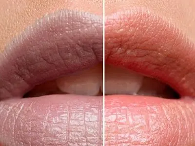 چطور تیرگی لب‌ها را از بین ببریم؟