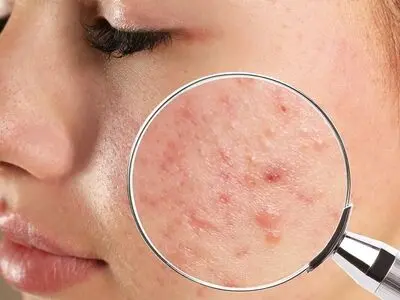 نوشیدنی اثرگذار بر آکنه