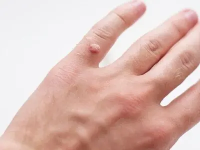 روش کندن زگیل‌های کوچک در خانه