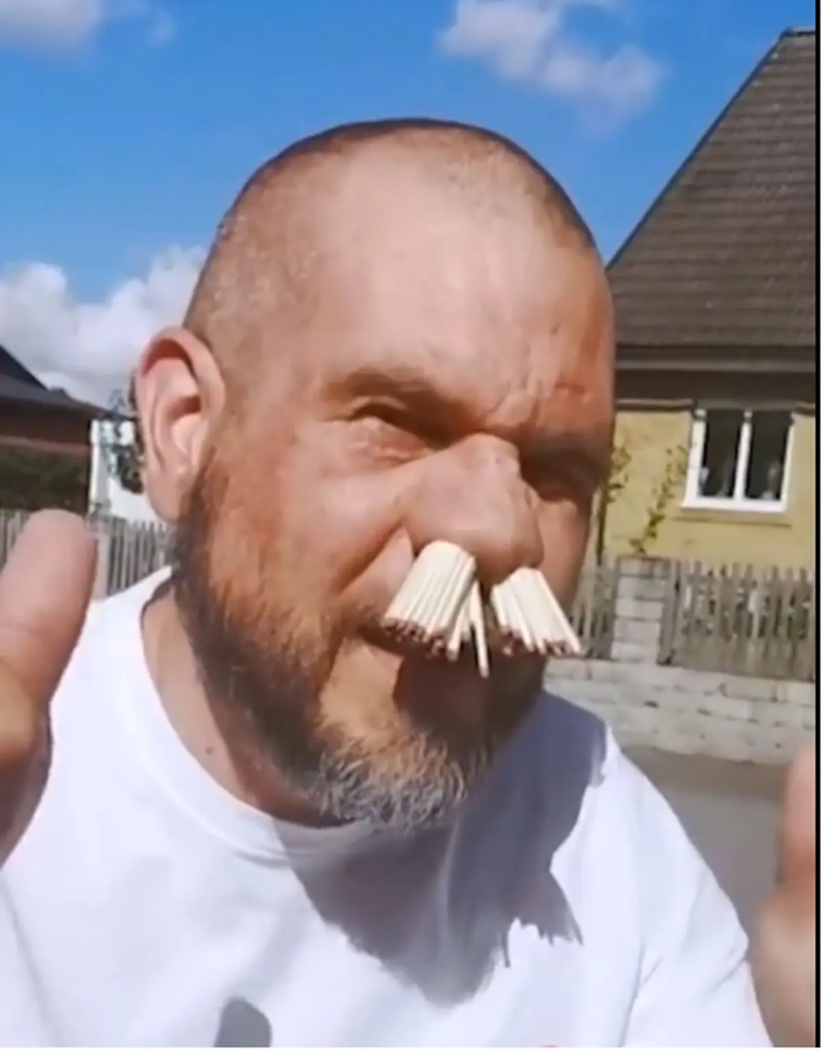 فرو کردن ۸۱ چوب کبریت در بینی؛ عجیب‌ترین رکورد گینس + فیلم