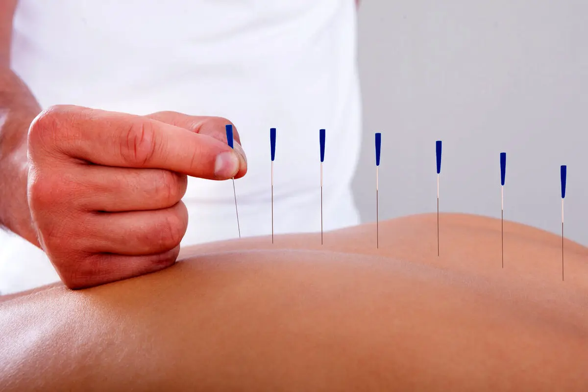 طب سوزنی برای سیاتیک؛ آیا سوزن‌ها از قرص‌ها مؤثرترند؟