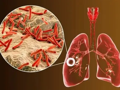 سونامی بیماری سل در ایران ؛ بیش از ۷ هزار نفر مبتلا شدند