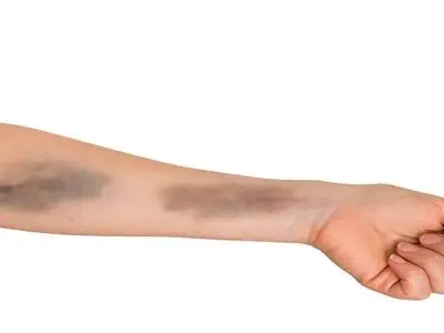 هشدار درباره خود به خود کبود شدن بدن