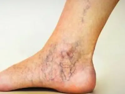 برای پیشگیری از واریس چه غذاهایی را نباید خورد
