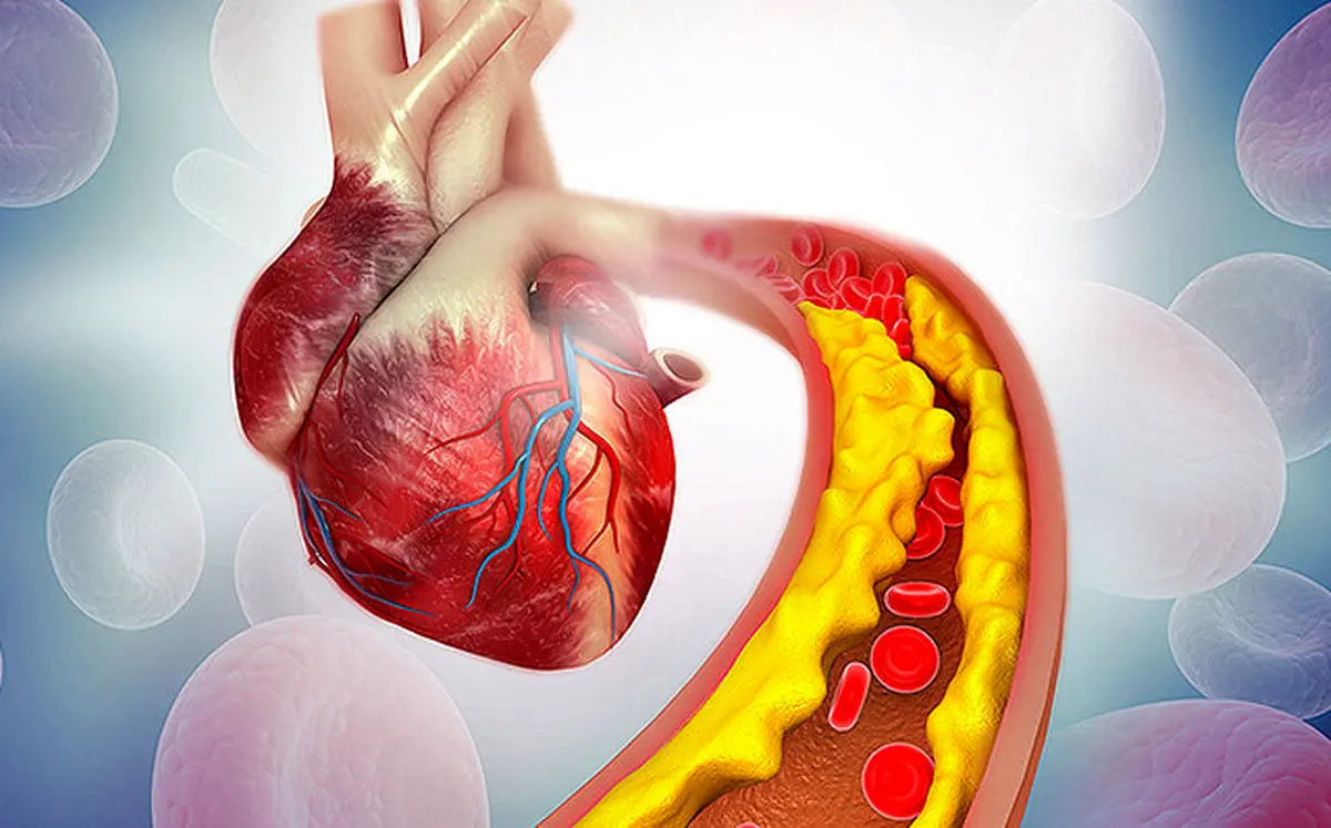 آیا باید از کلسترول و تری‌گلیسیرید بالا ترسید؟