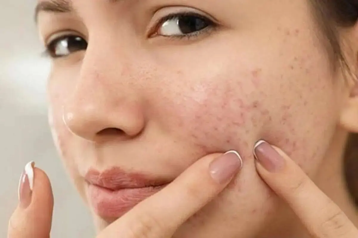 آیا جوش صورت نشانه بالا بودن تستوسترون است؟