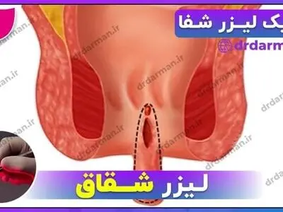 لیزر شقاق