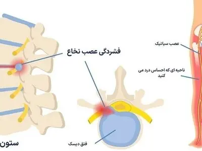 تفاوت دیسک کمر و عصب سیاتیک چیست؟