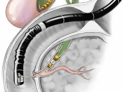 نصب پیشرفته‌ترین دستگاه کلانژیوسکوپی مجاری صفراوی در بیمارستان ابوعلی سینا شیراز