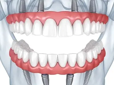 قیمت ایمپلنت همه دندانها چقدر است ؟ ( فول موس )