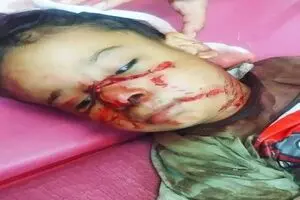 کودک ۴ ساله  شوشی مورد حمله‌ی سگ‌های بلاصاحب قرار گرفت