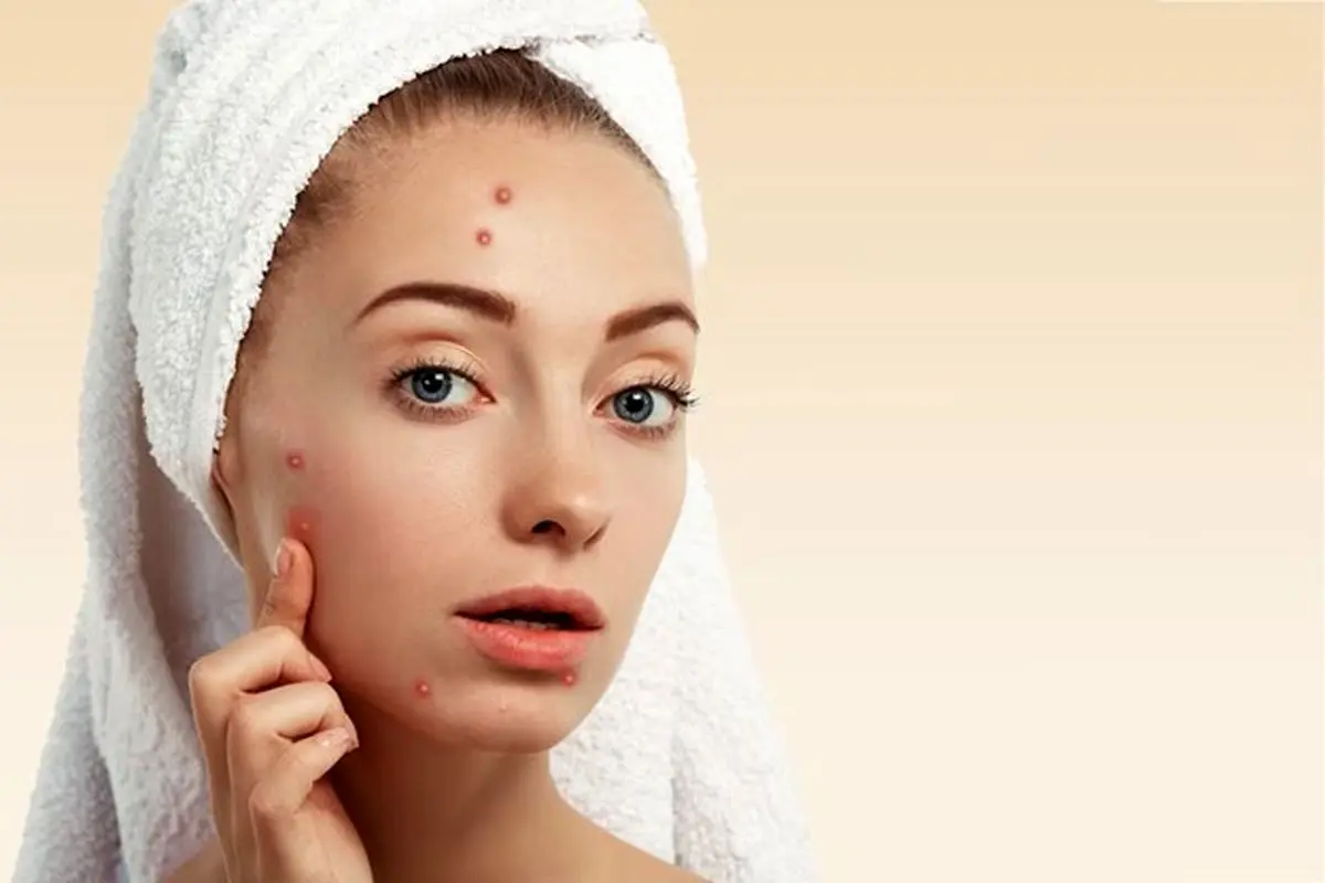 راهنمای خرید کرم ضد جوش