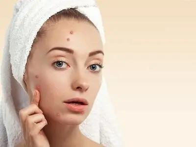 راهنمای خرید کرم ضد جوش
